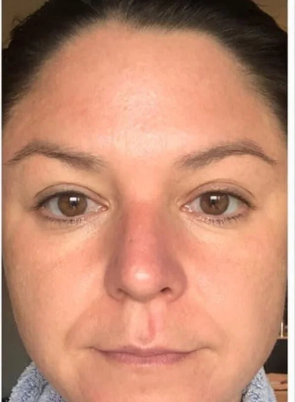 After photo: skin texture