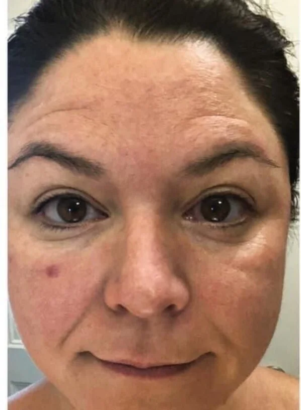 Before photo: skin texture