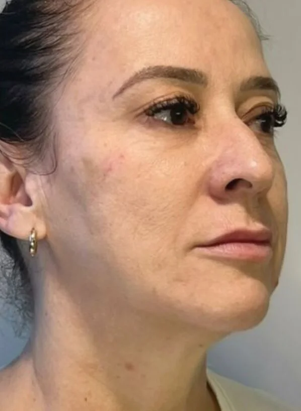 After photo: firmness & definition