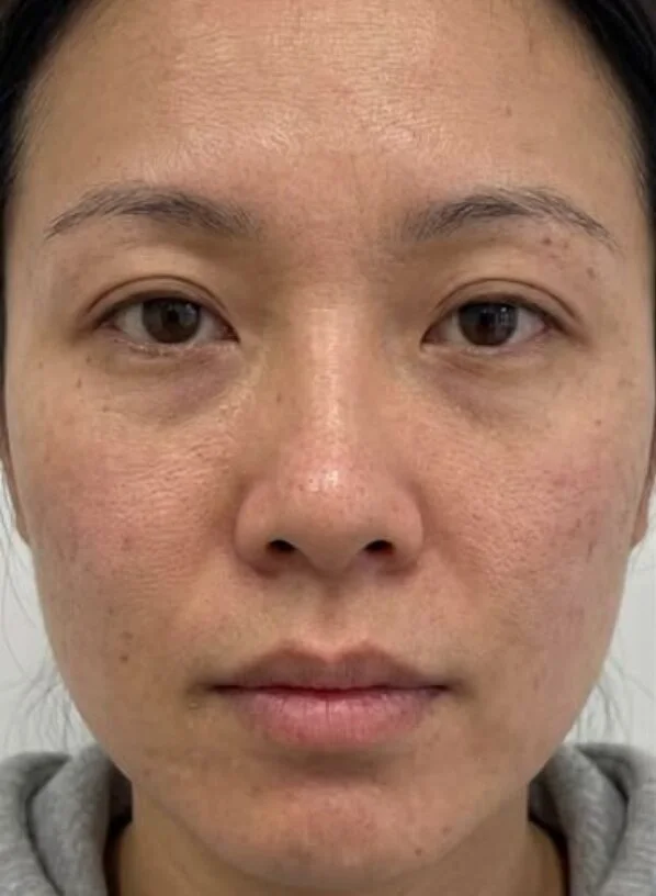 Before: guest with uneven, dull skin