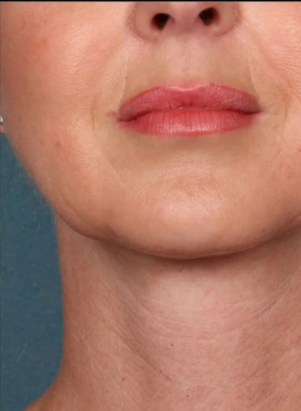 After photo: chin & jawline