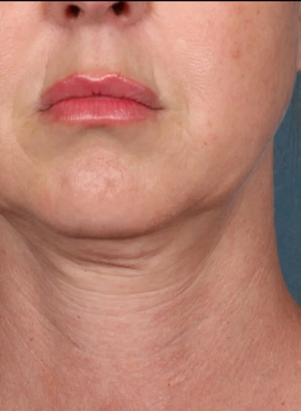 Before photo: chin & jawline