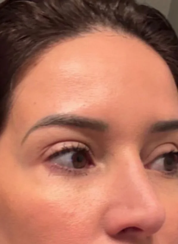 After photo: under-eye appearance