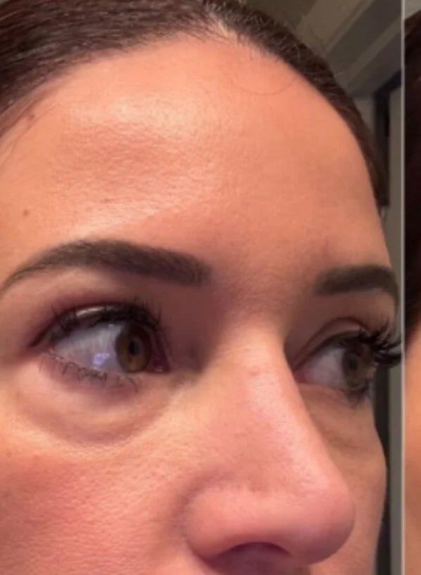Before photo: under-eye appearance